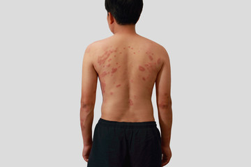Around Back view of man with dermatitis problem of rash ,Allergy rash