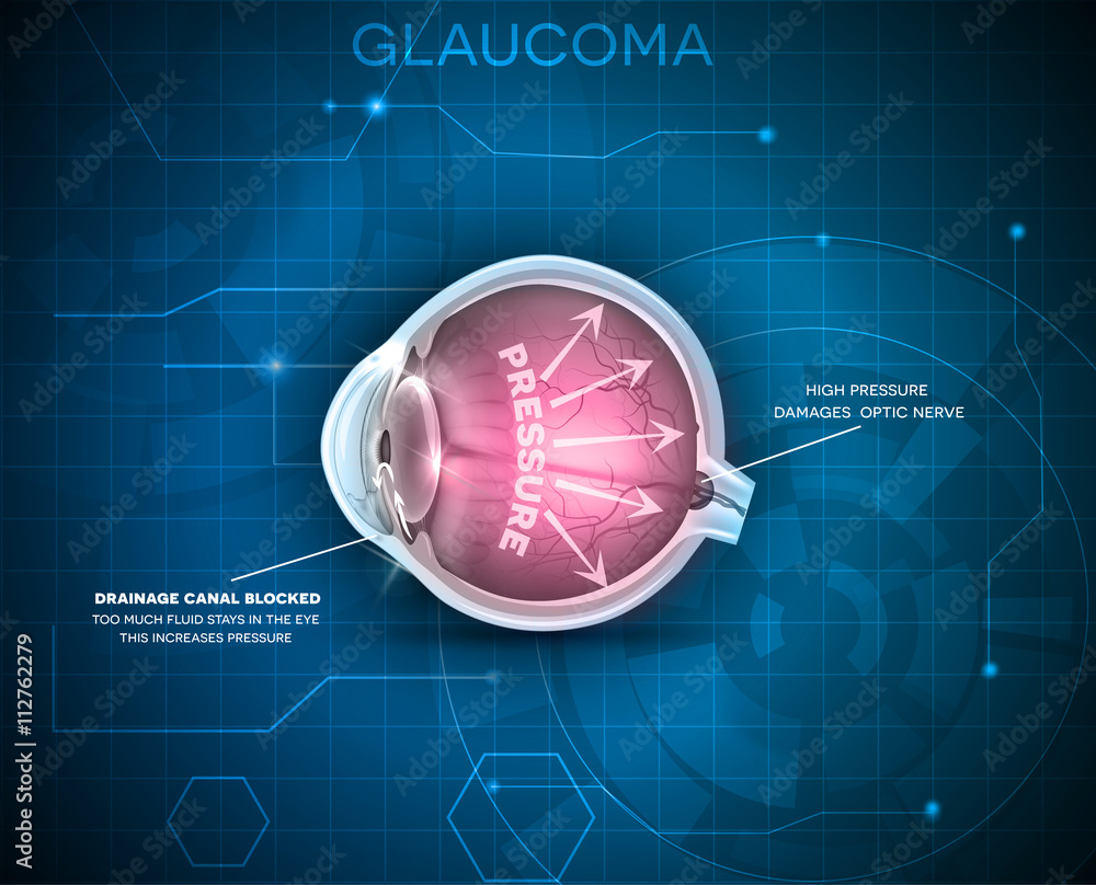 Wall mural glaucoma, vision disorder. detailed anatomy of glaucoma, eye disorder on a blue technology backgroun