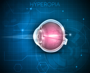  Hyperopia, vision disorder on a blue technology background. Hyperopia is being long sighted (far sighted). Near object seems blurry. 