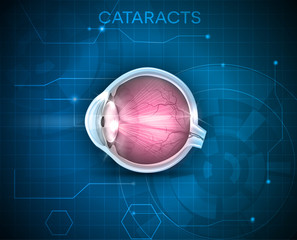 Naklejka premium Cataracts. Human vision disorder, detailed anatomy of cataracts and healthy eye.