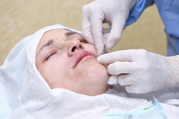 Obraz na płótnie Canvas Procedure of face lifting surgery.