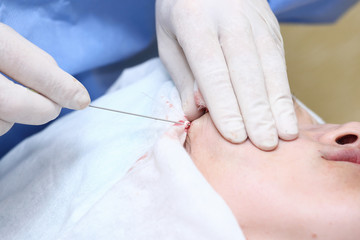 Procedure of face lifting surgery.