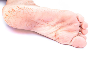 Closeup old woman cracked heels with white background, healthy concept
