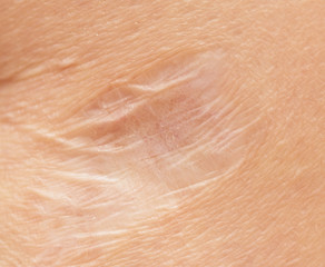 round scar on his leg macro