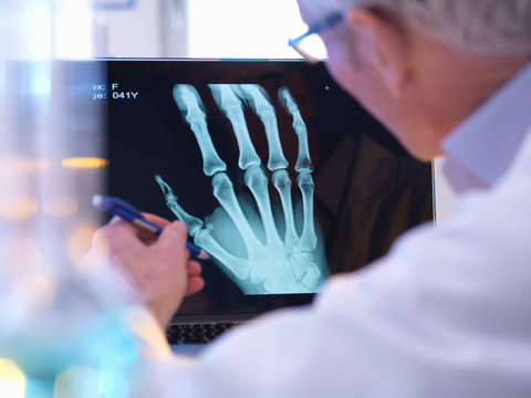 Radiographer looking at x-ray of hand fracture