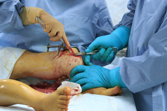 Two surgeons breakes the shin bone making the reshaping orthopedic surgery