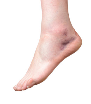 sprained ankle  isolated on white