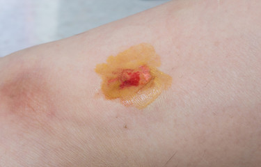 Fototapeta premium Wound on woman leg