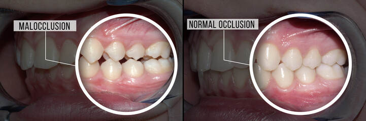 dental treatment malocclusion: before and after