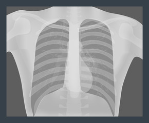 Chest X-Rays vector illustration. Medical imaging of lungs