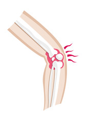 Diagram of an injured leg and joint. Isolated Editable Clip Art.
