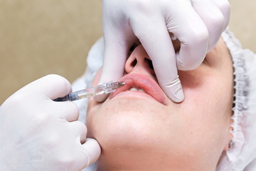 Procedure of lip injection with filler.