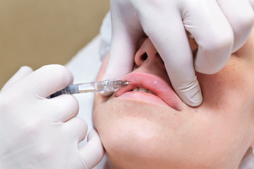 Procedure of lip injection with filler.