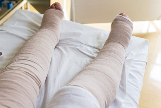 Terapista che esegue il bendaggio  elastocompressivo su arti inferiori con problemi di edema linfatico