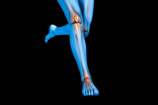 tibial stress syndrome