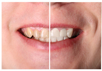 tooth restoration before and after treatment