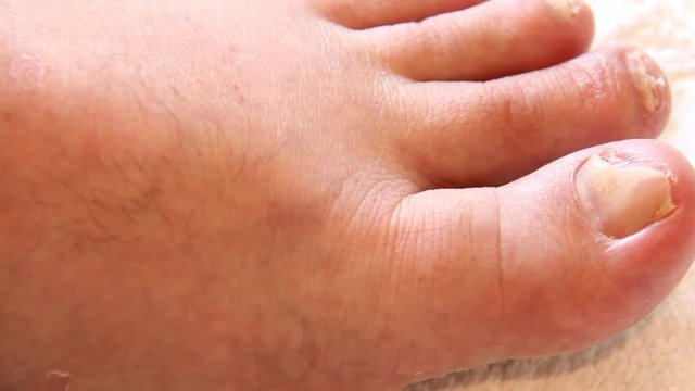 Left Leg of Elderly Man With Nail Fungus on the Toes