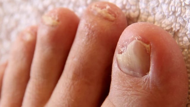 Closeup Nail Fungus on the Toes