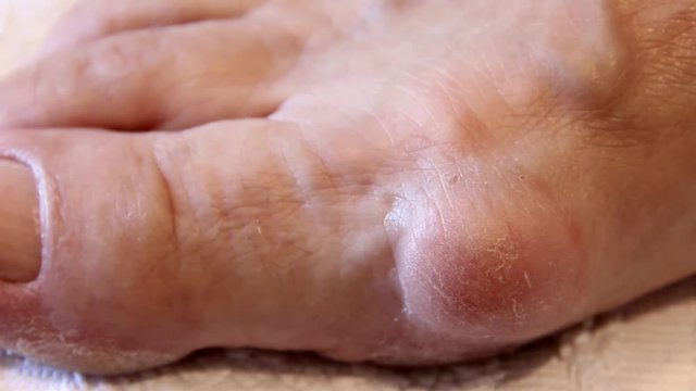Valgus Deformity of Woman Leg