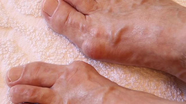 Valgus Deformity of Female Legs
