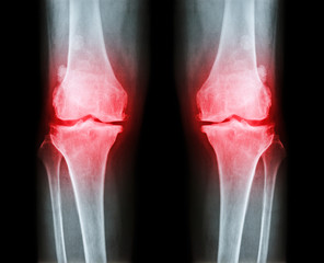 Osteoarthritis both knee .  film x-ray AP ( anterior - posterior ) of knee show narrow joint space , osteophyte ( spur ) , subcondral sclerosis