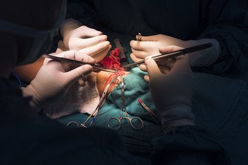 arteriovenous fistula operation