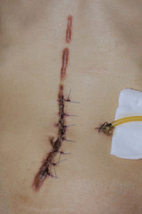 scar from operation  with a black fiber. Stitched up skin after