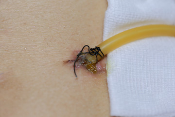 Obraz premium scar from operation with a black fiber. Stitched up skin after