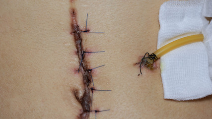 scar from operation  with a black fiber. Stitched up skin after