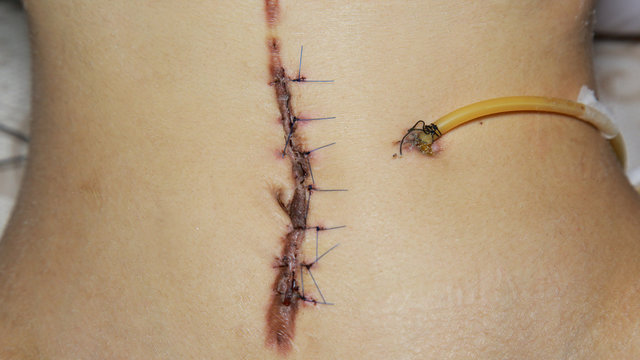 Scar From Operation  With A Black Fiber. Stitched Up Skin After