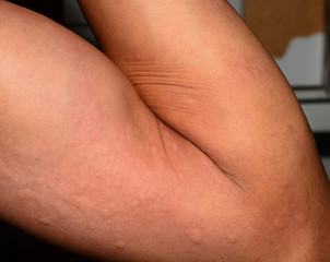 ill allergic rash dermatitis eczema skin texture.