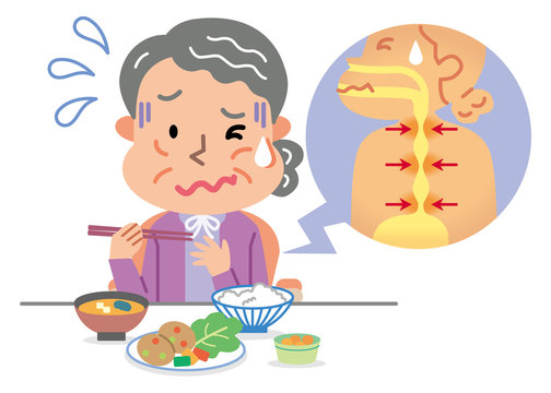高齢者　女性　食道狭窄