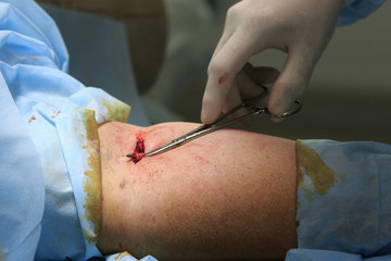 Surgeon makes access to vein on a hand for catheter installation close-up