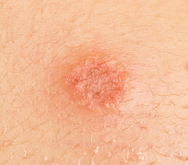 Fototapeta premium round abrasion on the skin