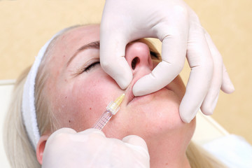 Procedure of lip injection with filler.