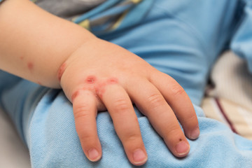 Kind legt Hand mit Hautkrankheit auf dem Knie ab 