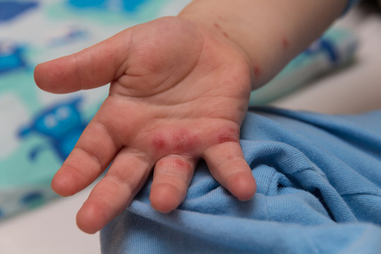 Kind zeigt seine Hand mit Hautkrankheiten