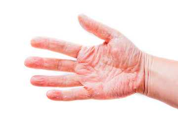 The problem with many people - eczema on hand. Isolated background