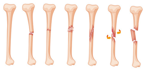 Diagram of leg fracture in different stages - obrazy, fototapety, plakaty