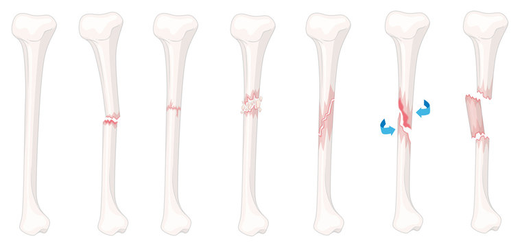 Different stages of leg fracture