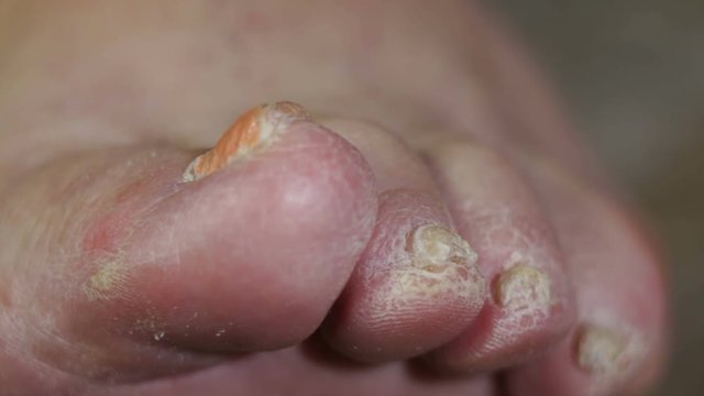 Macro of ill senior female toes and nails.