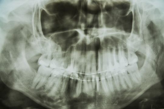 the chest x-ray of your jaw and teeth 