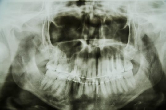 the chest x-ray of your jaw and teeth 