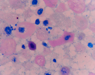 Fototapeta na wymiar Abnormal cells pink cells with microscope.