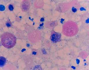 Abnormal cells pink cells with microscope.