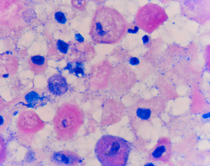 Abnormal cells pink cells with microscope.