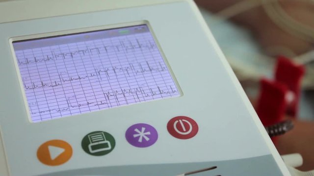 EKG ECG electrocardiography device monitor