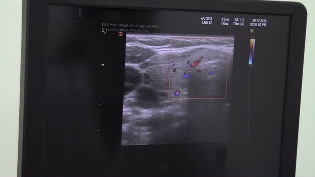 Ultrasonic diagnostics. Ultrasound monitor. Monitor with ultrasonic interactive echogram pictures