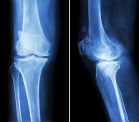 Osteoarthritis knee .  film x-ray knee ( anterior - posterior and lateral view )  show narrow joint...