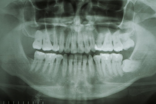 Dental X-Ray. A panoramic x-ray of a mouth, with intact wisdom t